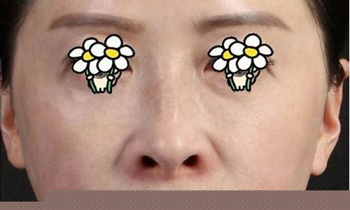 玻尿酸法令纹疙瘩